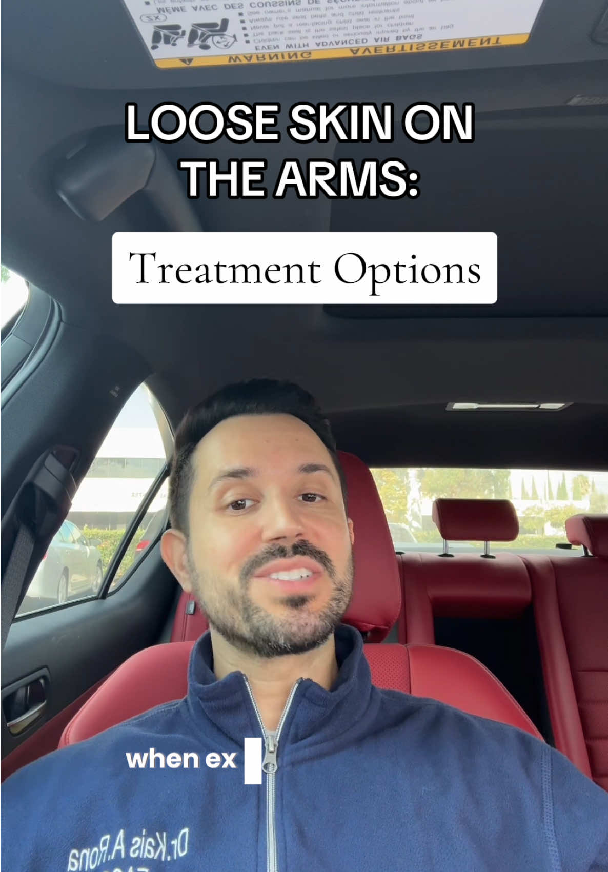 Many patients are troubled with loose skin on the arms. In some cases exercising is just not enough to provide adequate skin retraction. For these patients that have excessive loose skin which compromises their quality of life, there are excellent treatment options. In patients with limited skin laxity a less invasive option like quantum RF can provide amazing results with minimal downtime. While patients with significant loose skin are best treated with a surgical arm lift (brachioplasty). Depending on the severity and extent of the loose skin, some patients may need what’s referred to as an extended brachioplasty. In an extended brachioplasty, excess skin on both the arms and lateral chest wall (bra line) are removed. Many post-bariatric surgery patients require an extended brachioplasty as a result of the large amount of weight they often lose. #armlift #inmode 