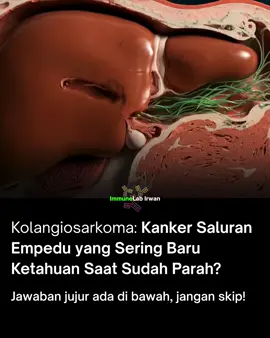 Kolangiosarkoma (Cholangiocarcinoma) adalah kanker langka tapi sangat ganas yang menyerang saluran empedu. Awalnya sering tanpa gejala jelas. Saat muncul, biasanya sudah terlambat: Kulit dan mata menguning (jaundice) Perut nyeri dan membesar Berat badan turun drastis Urin gelap, feses pucat ⚠️ Masalahnya, kanker ini cepat menyebar dan pilihan terapi terbatas. Yang bikin makin sulit: sistem imun gagal mengendalikan sel kanker. 💡 Harapan datang dari terapi imun, yang membantu tubuh memperkuat pertahanannya, melawan sel abnormal, dan memberi peluang hidup lebih baik. 👉 Konsultasi & info terapi imun hubungi: WA +62 858-9004-0579