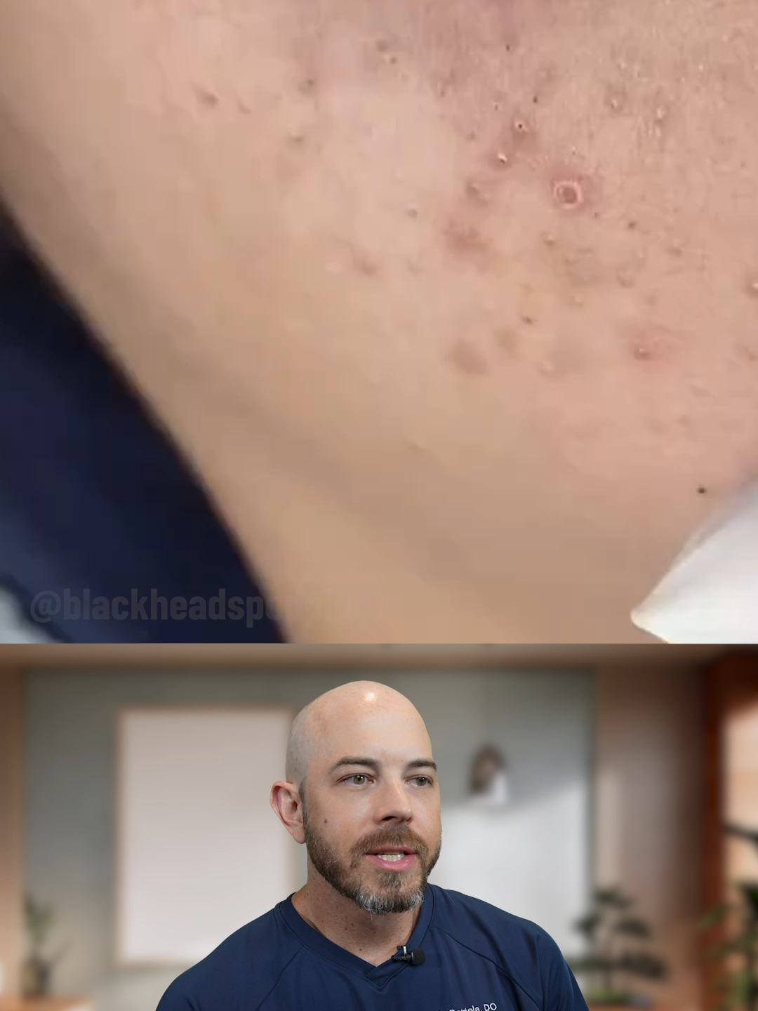 Blackheads on the cheek get evicted🏠 (credit: @blackheadspopping1) #skincare #blackheads #fyp