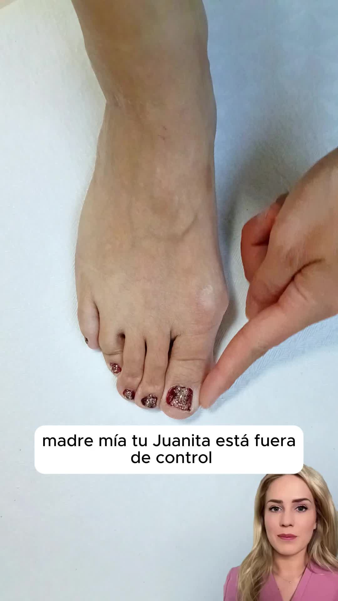 ¡ALTO A LOS JUANETES! ✋😥 Elimina dolor, evita cirugías y SALVA TUS PIES. Nuestro corrector da alivio AL INSTANTE + alinea dedos. Camina cómoda con TODOS tus zapatos 👠✨ ¡Previene riesgos de amputación! #footcare #foottreatment #shoecare #footcomfort #bunioncorrector #pedicuretools #pedicurekit #footcareessential #bestnurseshoes #athomepedicure #pedicureathome #shoedesign #footcareessentials #JuanetesAdios #CuidadoDePies #PiesSinDolor #CorrectorDeJuanetes #SaludPodológica #PedicuraEnCasa #TikTokLoRecomienda #TikTokShopFinds #ProductoMilagro #BienestarPodológico #TikTokMadeMeBuyIt #MustHaveGadget #PainFreeLife #footwellness