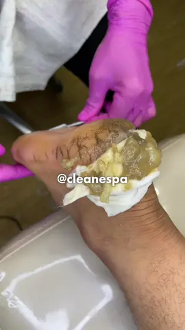 Olha o resultado desse pé 😱😱😱😱😱 #manicure #foryou #spa #asmr #plastica 