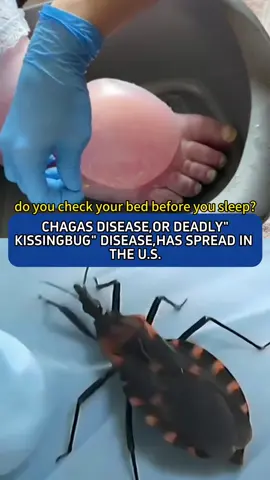 CHAGAS DISEASE,OR DEADLY 
