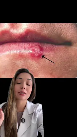 #herpes #virus #farmacia 