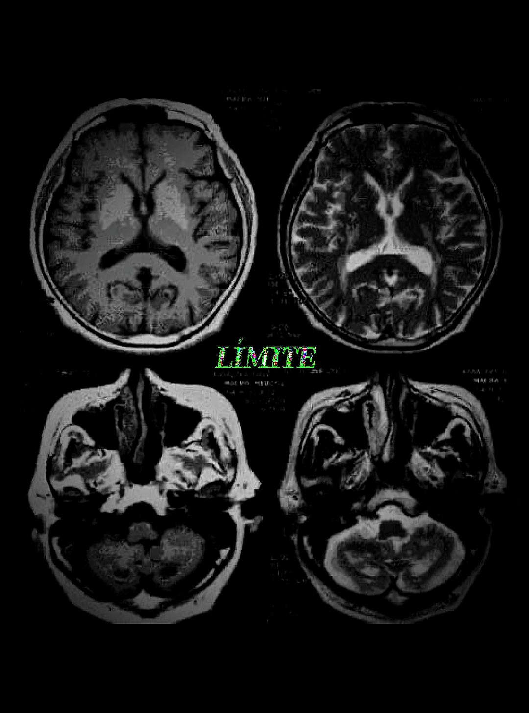 (TLP) Explicado científicamente 🧠 #neurociencia #cientificos #cerebro #psicologia #fyp 