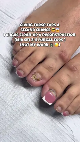 Giving These Toes a  SECOND CHANCE 😎😱 Fungus Clean-Up & Reconstruction  (MID SET 3-5 fungal toes ) (NOT MY WORK 🧟‍♀️ 😓) #nailfungus #toenails #toebbl #medicalpedicure #explorepage✨ 