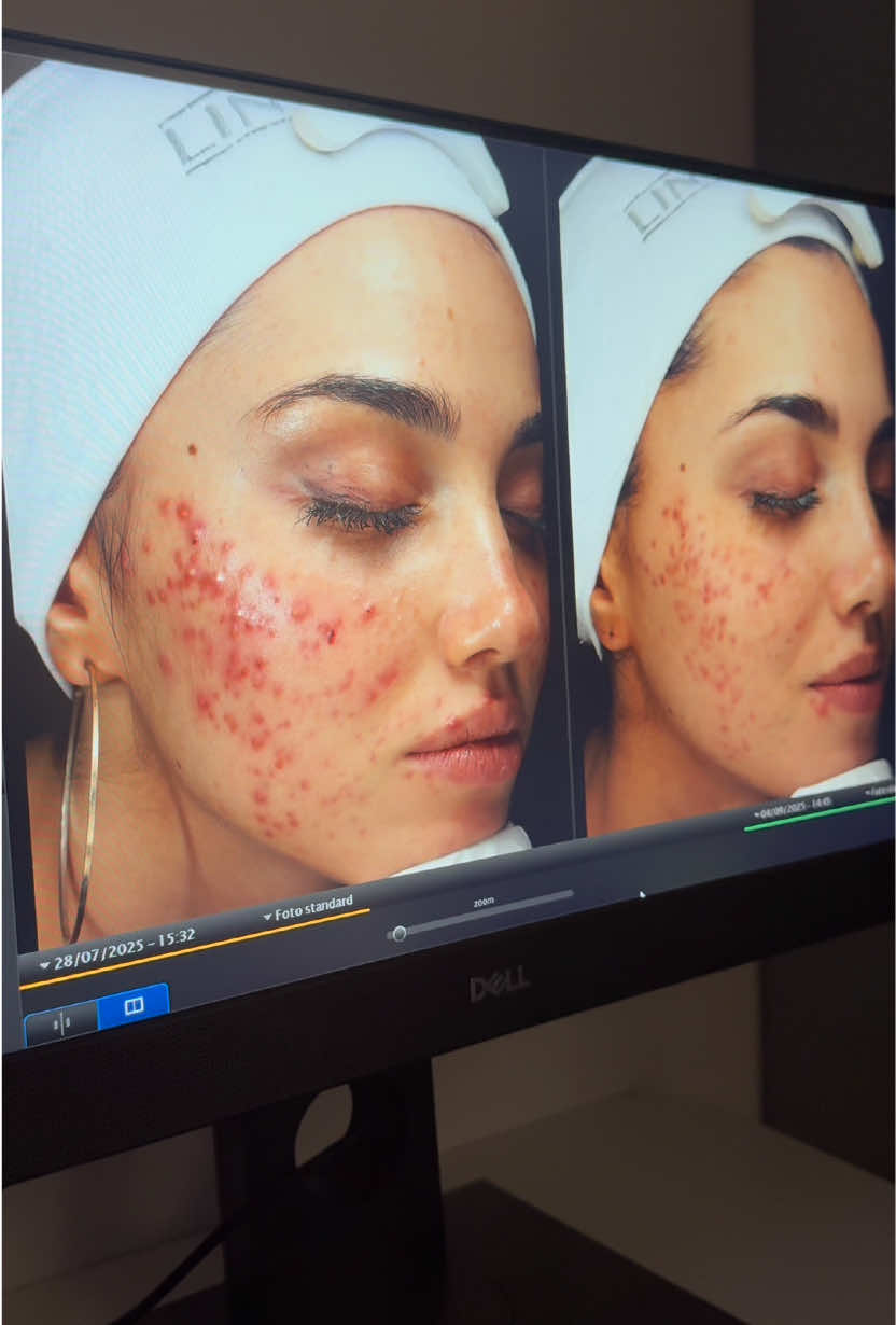 Vi porto con me dal mio dermatologo🤍 ciao amici, mi chiedete spesso chi è il professionista che è stato in grado di migliorarmi così tanto in poco tempo, così ho deciso finalmente di presentarvelo! io sono super felice dei miglioramenti che sto ottenendo , e voglio documentare qui con voi il tutto per non farvi mai perdere la speranza, cercate sempre la forza di lottare e sorridere perché prima o poi la luce arriva, non può piovere per sempre.. ovviamente questo è solo l’inizio, ma questi piccoli passi avanti mi danno tanta forza di vedere tutto con positività e non perdere mai le speranze  Il mio dermatologo, (e psicologo aggiungerei 😹) è il Prof. Andrea Corbo, e la sua clinica la Medical Spa🤍 per qualsiasi dubbio scrivetemi qui nei commenti che vi leggo tutti, un abbraccio!! #suppliedby 