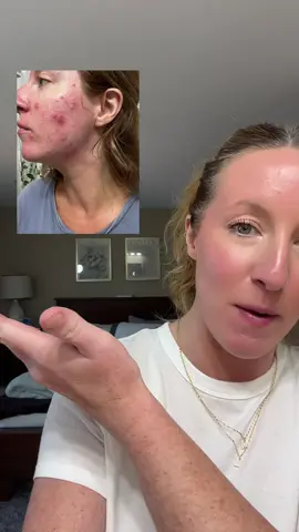 Skinflooding and Korean skincare changed my skin, just he consistent with it! @anua_global @Anua Store US #anuasuperbrandday #koreanskincare #tiktokshopcreatorpicks #glassskin #cysticacnehealing 
