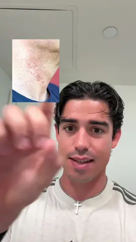 I wish I knew this when shaving 🪒😳 #marcosphilip #mensselfcare #ingrownhairtreatment #ingrownhair 