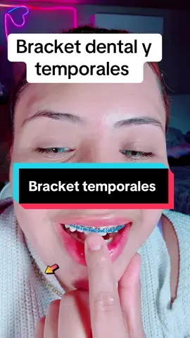 #Dental #braces #fhasion #brackets 