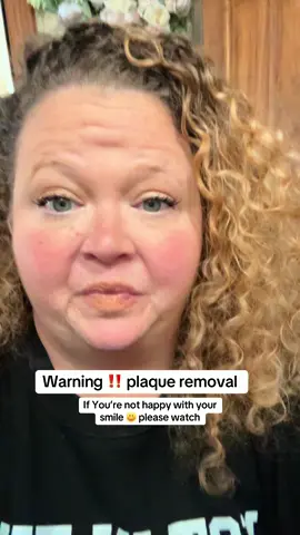 #Plaque #Tartar #DentalHealth #NOBS #Teeth 