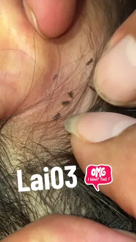 lice in her head, and she was very itchy#omg😂😂😂😂🤣🤣🤣🤪😋😍 😱😱#lice #liceremoval 
