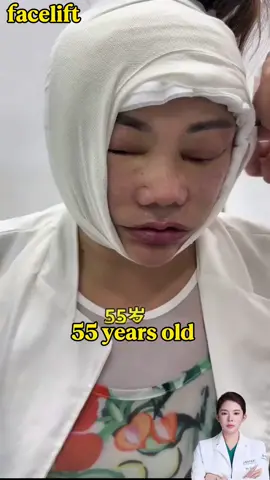 #facelift #plasticsurgery #antiaging #momglowup #拉皮 