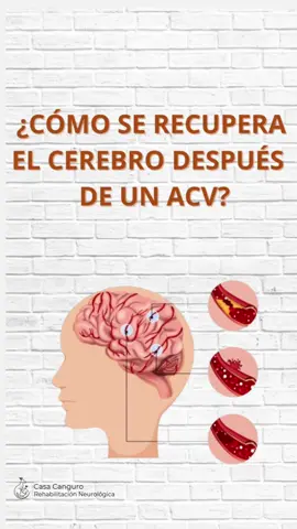 🧠 Un ACV puede cambiar tu vida, pero la rehabilitación adecuada marca la diferencia en el proceso de recuperación  🦘 En Casa Canguro estamos contigo en cada paso y te acompañamos con:  💪Terapia física: Después de un ACV, es común perder fuerza, equilibrio y movilidad. La terapia física ayuda a que el cuerpo vuelva a moverse, estimula la conexión entre cerebro y músculos, y permite recuperar independencia en actividades cotidianas. Cada ejercicio, por pequeño que parezca, representa un gran avance hacia tu bienestar ✨ 🗣️ Terapia de lenguaje: El ACV también puede afectar la comunicación, haciendo difícil hablar, comprender o incluso recordar palabras. Con la terapia de lenguaje trabajamos para que recuperes tu voz, tu capacidad de expresarte y la confianza para volver a conectarte con los demás 🫂 🦘 En Casa Canguro, nuestro objetivo es acompañarte de forma personalizada, brindándote terapias adaptadas a tus necesidades 💌 Si tú o un familiar sufrió un ACV, no dudes en escribirnos! Estamos aquí para ayudarte 💙 #ACV #terapiafisicayrehabilitacion #terapiadelenguaje #rehabilitation #derramecerebral 