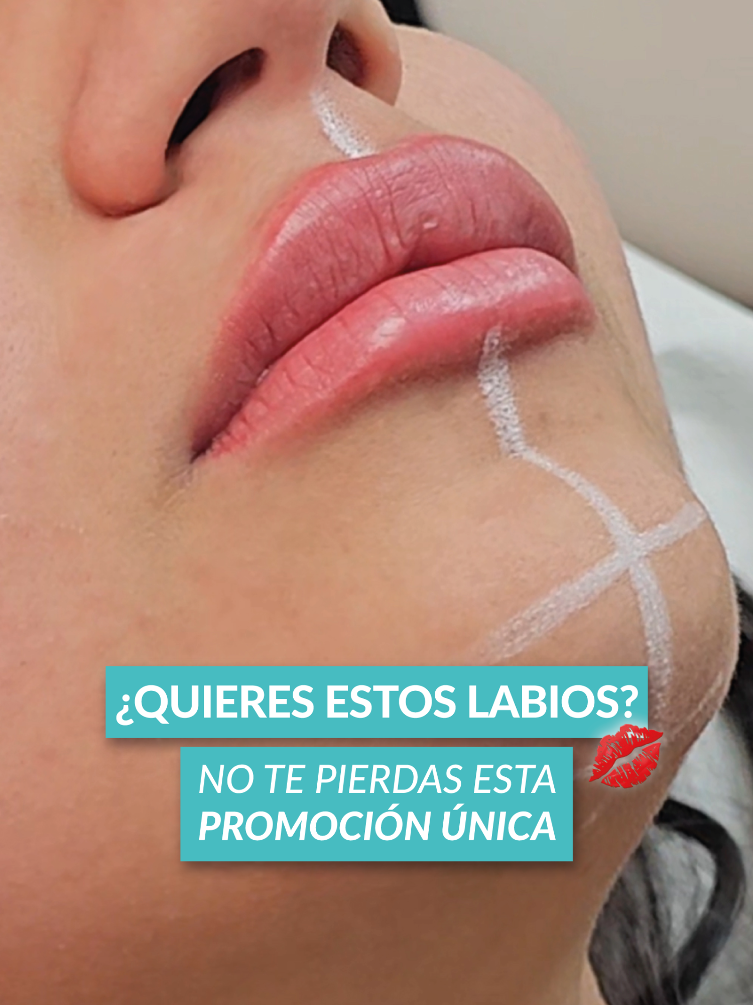 💋 ¿Quieres unos labios así? Con nuestra armonización de labios con ácido hialurónico Yvoire, consigue volumen, forma y ese toque fresco y natural que tanto deseas 😍 💥 Resultados inmediatos y duraderos ✅ Procedimiento seguro 😱 Súper promoción por tiempo limitado 📲 ¡Reserva hoy mismo y presume los labios que siempre soñaste! 📲 Atención previa cita 📞 959 319 700 📍 Av. Belaunde Oeste #888 Piso 2 – Comas / Ref: Cruce con Av. Universitaria . . . #EstheticFit #Labios #ÁcidoHialurónico #MedicinaEstética #armonizaciónfacial