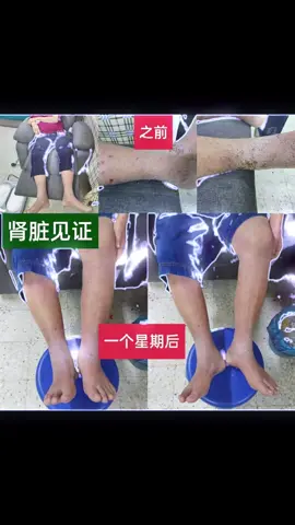 【P90见证分享】 这位Uncle Raymond 肾脏功能剩下19% 没办法排水，导致脚和肚子严重肿胀😱 双脚和肚子都是硬的‼️ 而且双脚非常痒，导致晚上无法入睡😩 因为P90的出现 让他…在短时间里身体得到非常棒的改善 ♻️使用P90一个星期 （一天使用1/2次， 使用强度3️⃣） ✅肿胀开始消了 ✅双脚和肚子也开始软了 ✅脚也不痒了‼️ —————————————————————————— 🫰🏻用过P90的见证🫰🏻 “脚痛不见了” ， “关节也不再疼痛了”，“睡眠更了！”…身体的毛病都得以改善了，同时也重获健康的人生💚  ｜医学革新领域｜科学养生为健康续航｜ 🏋🏻双脚放在仪器上，只需要半个小时 = 120分钟的运动！ 🏋🏻 只须每天30分钟： ✅可让细胞回复正常 👍 ✅有助血液循环👍 ✅排出体内毒素👍 ✅舒缓及改善身体痛症👍 ✅舒缓及改善身体炎症👍 ✅有助血压回复正常水平👍 ✅有助血糖回复正常水平👍 ✅加速新陈代谢，促进细胞再生👍🏻有助减肥👍 ✅提升身体褪黑激素，改善睡眠质素👍 ✅舒缓压力，改善情绪或焦虑问题👍 ✅有助头部微血管循环，降低中风及脑退化风险👍 ✅有助抗衰老，有助减肥👍 一架【Olylife 太赫兹兆能仪】轻松帮助您改善全身上下各类毛病！ 马上PM下单吧！ 注⚠️现在下单还可以获赠价值RM1650的折扣卷 Olylife脉冲磁电场养生细胞仪 拥有十多年 PEMF 技术经验、使用美国FDA认可保健设备技术，并无副作用，符合安全标准。信心保证。 可亲临体验参观及 预约免费体验⏰⏰ 🌿 欢迎来体验我们引进的 Olylife P90 高科技理疗仪，通过无痛、非药物、非侵入式的高频能量调理，帮助你舒缓症状，改善体质。 📍CL Healthy · Jason（Seri Kembangan） 📦提供🆓体验 · 产品订购 · 欢迎加盟代理 📲WhatsApp：017-616 2918 #fyp #olylife #malaysia 