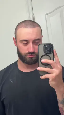 13 day post hair transplant! #hairtransplant #istanbul 