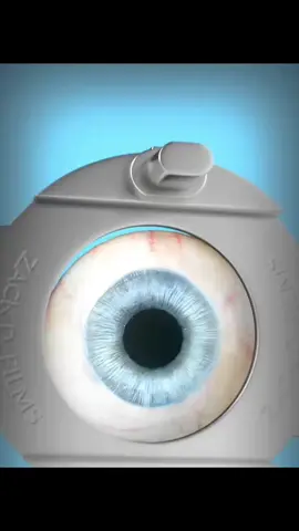 Fun fact: operasi LASIK itu nggak seseram yang lo bayangin. Prosesnya cepet banget, biasanya cuma sekitar 15 menit untuk dua mata! LASIK dilakukan dengan laser super presisi yang membentuk ulang kornea, supaya cahaya bisa masuk ke mata dengan tepat. Hasilnya, penglihatan jadi lebih jelas tanpa kacamata atau lensa kontak. Bahkan, sebagian besar orang bisa langsung lihat lebih terang hanya dalam 24 jam setelah operasi. Sumber video: Zack D.Films