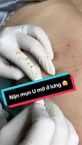 Nặn mụn u mỡ ở lưng cho khách kimHằng#spakimhang #spabaoloc #nặnmụnbằngtay #nặnmụnbảolộc #umỡlưng 