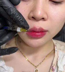 Tạo hình cánh môi cứ phải gọi là xinh nhuéc cái nách 😍😍😍😍 #fillers💉 #FillerUyTin #haiphong #Tiêmfiller #haiphongphoto 