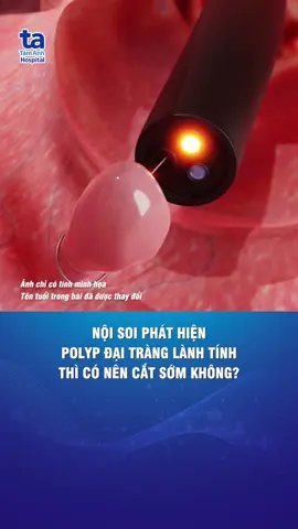 Không phải polyp nào cũng cắt, sẽ có dạng lành tính và ác tính #benhvientamanh #polypdaitrang #ytecongnghecao #TiktokForHealth #ProudVietnam 