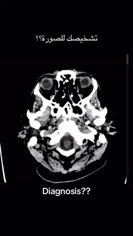 Diagnosis???????????? #radiology #اشعة #جامعة_القدس_ابو_ديس #mri #ct 