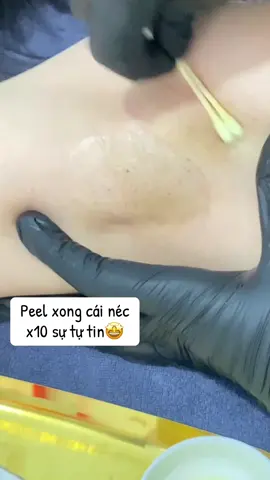 ✨ Tạm biệt thâm nách – Tự tin giơ tay mọi lúc! ✨ 👉 Peel nách giúp: 	•	Làm sáng vùng da thâm sạm, xỉn màu 	•	Giảm viêm nang lông, da sần sùi 	•	Khử mùi, làm sạch sâu lỗ chân lông 	•	Cho làn da nách trắng mịn, khô thoáng 💎 Quy trình an toàn – nhẹ nhàng – không đau rát 💎 Hiệu quả thấy rõ sau liệu trình đầu tiên 📌 Đặt lịch ngay hôm nay để tự tin diện áo sát nách, bikini không lo ngại! #peelnach #tritham #thuykieubeauty8  #spabacninh #duocmypham