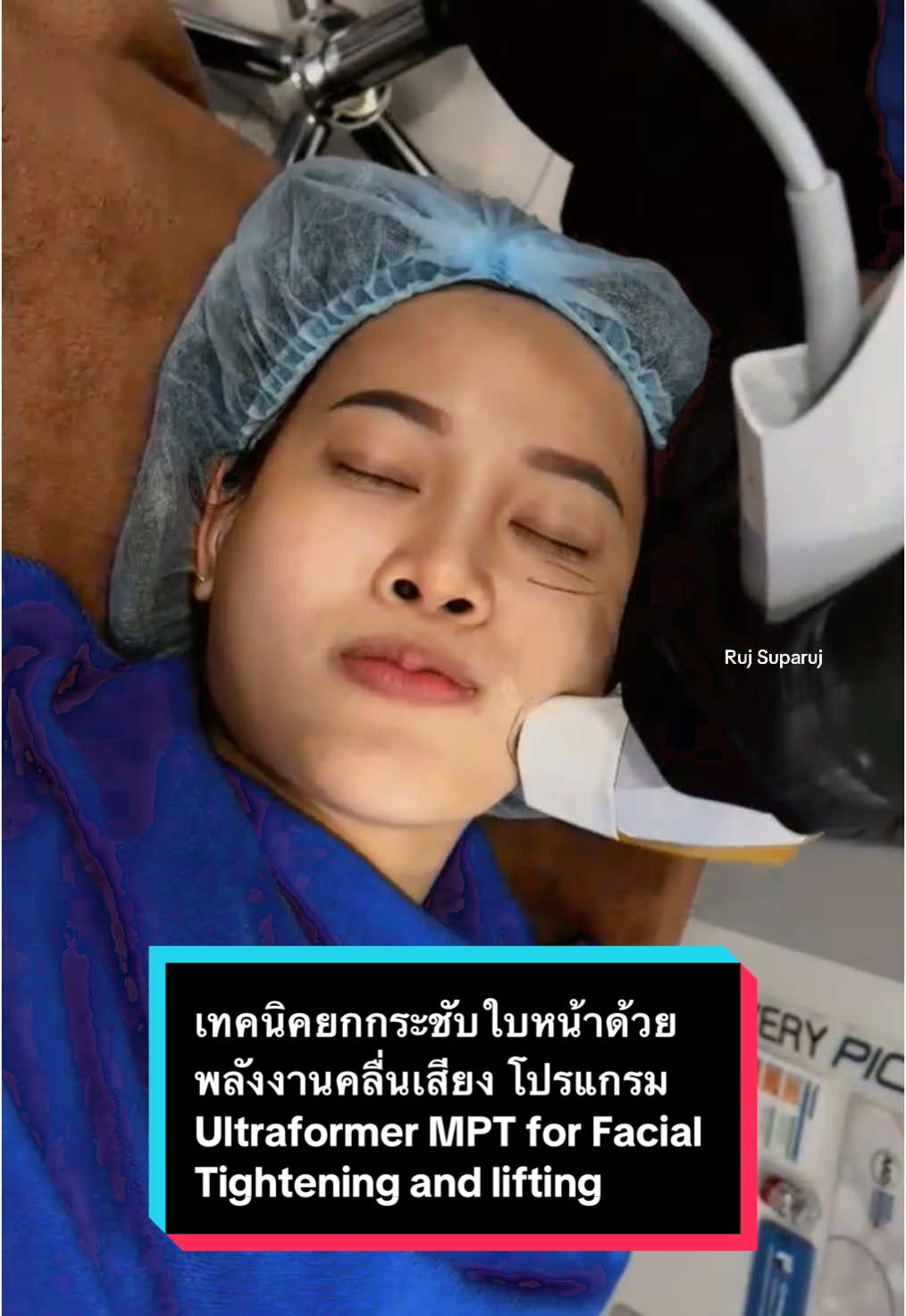 เทคนิคยกกระชับใบหน้าด้วยพลังงานคลื่นเสียง โปรแกรม Ultraformer MPT for Facial Tightening and lifting โปรแกรม #ultraformermpt โปรแกรม #ultraformer #ยกกระชับ #หน้าเรียว  @Ruj Suparuj 