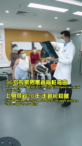 36-year-old male patient from Inner Mongolia had spinal curvature 28 years of upper body tilt and leg length discrepancy in walking #doctor #hospital #family #tiktok #foryou #surgeon 