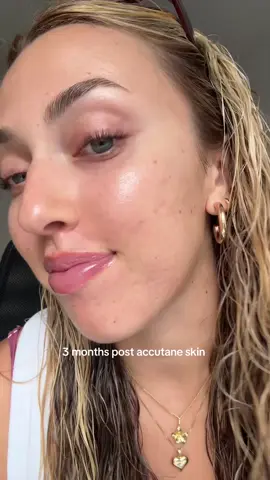 it’s giving glass skiiiinnnnn??? I can’t believe this is my skin oh my gosh #accutane #acndscar #acnescars #acneskincare #acneproneskin 