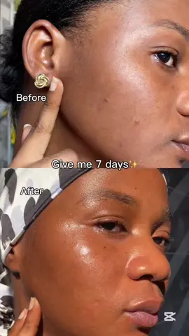 Say goodbye to acne in just 7 days✨ #purito #panthenolcream #acnetreatment #realpostacnecream #realpostacnecreamchallenge  @PURITO SEOUL 
