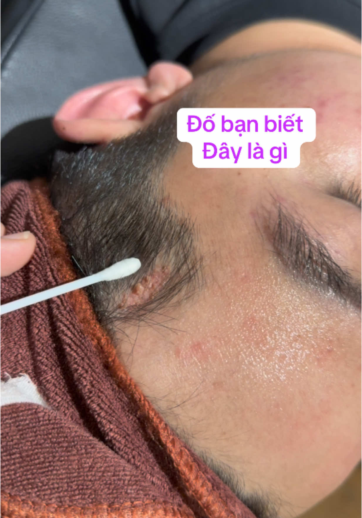 Đố bạn biết đây là gì? Gợi ý: ko phải 1 bệnh lây nhiễm nhé #dalieu #botsuithuongbi #bacsydung #hỏi 