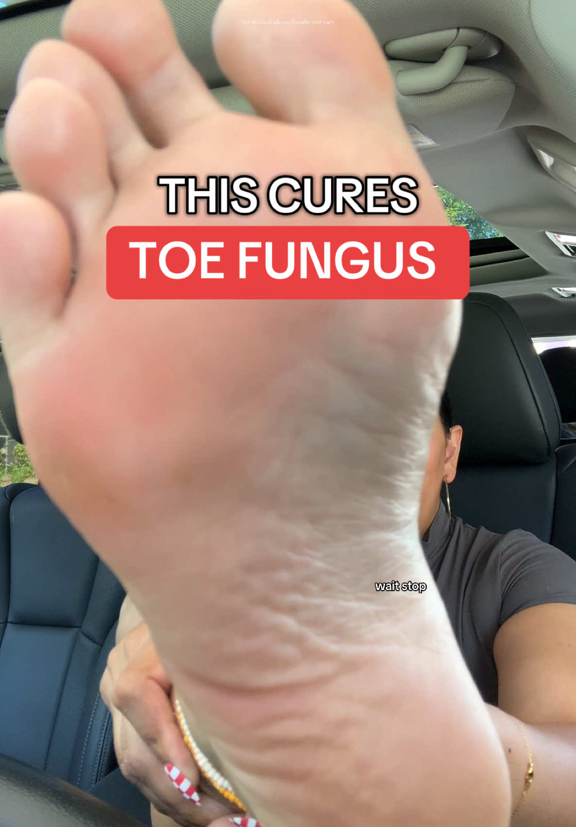 #toefungus #fungus #lunavia #feetcare #creatorsearchinsights 