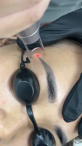 Xoá mày không tốn nhiều tg, xoá 1 lần mở hẵn 50% luôn ạ #xoamaylaser #spanguyendung 