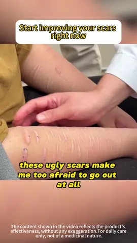 Tips for painlessly improving scars#skincaretips #GlowUp #beautyhack #confidenceboost #getreadyforfashionweek 