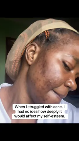 From hiding indoors ➡️ to loving my skin 🥹✨ Original products only | DM to start your glow journey 💕#tiktokcameroon🇨🇲 #ClearSkinJourney #GlowingSkin 