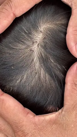 #omg #lice #liceremoval 😱😱😱#amazing 