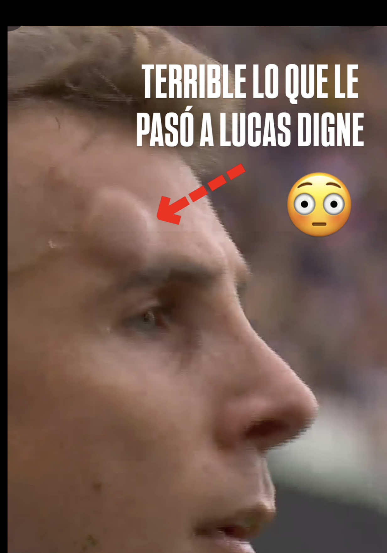💢🤕 ¡¡¡VAYA CHICHÓN DE LUCAS DIGNE!!! El del Aston Villa sufrió un terrible golpe en la frente en el partido ante Everton. 🫤 ¿Lo dejarías seguir jugando? #PremierLeagueTelemundo #PremierLeague #astonvilla #lucasdigne 