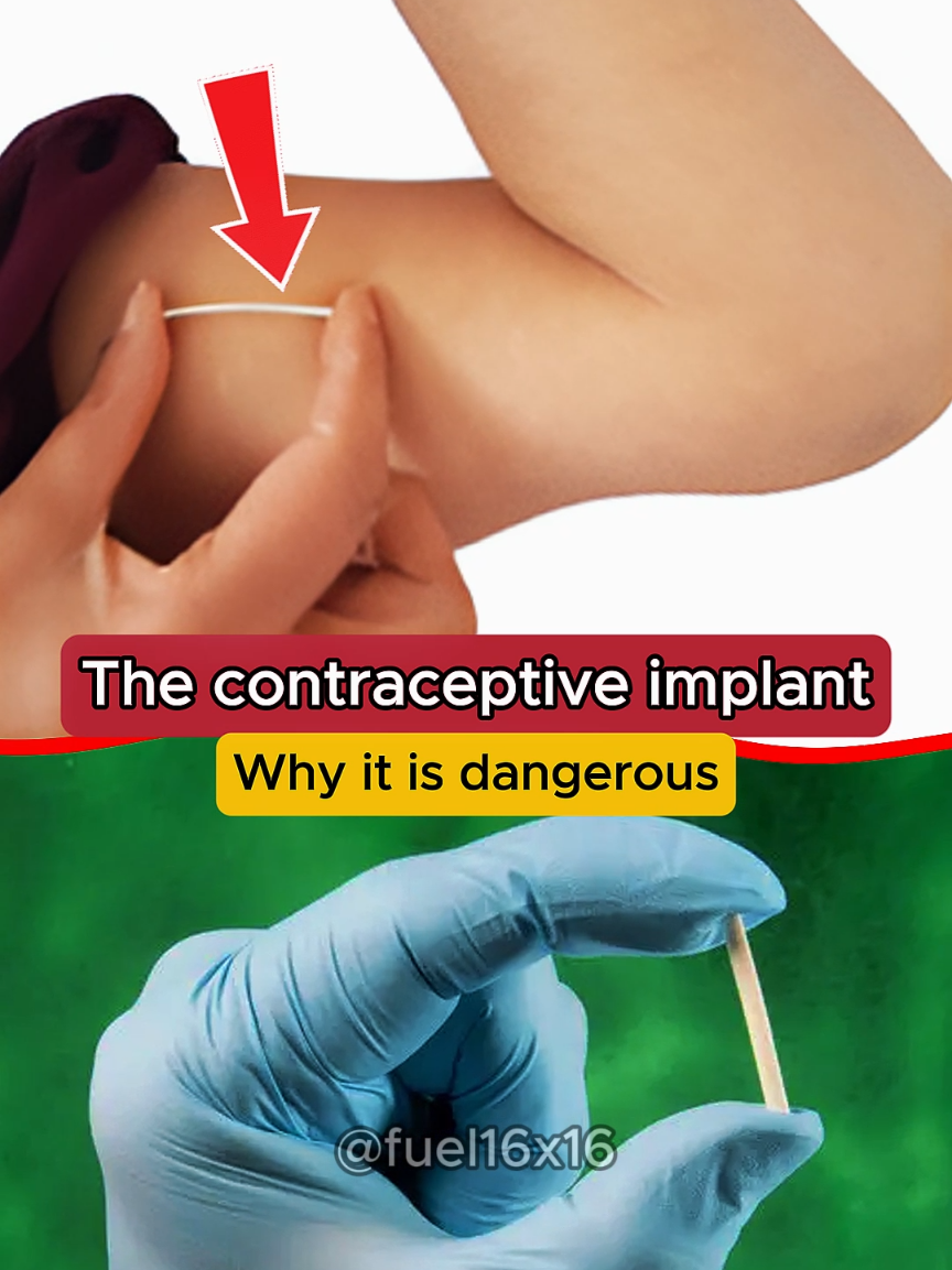 The contraceptive implant.. #contraceptive #implant #pain #healthtips #signs 