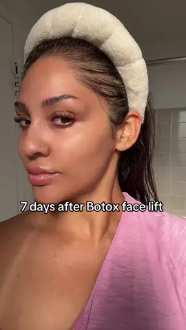 Can’t frown no more 😊 #botox #tox #fillers #facelift #wrinkles 