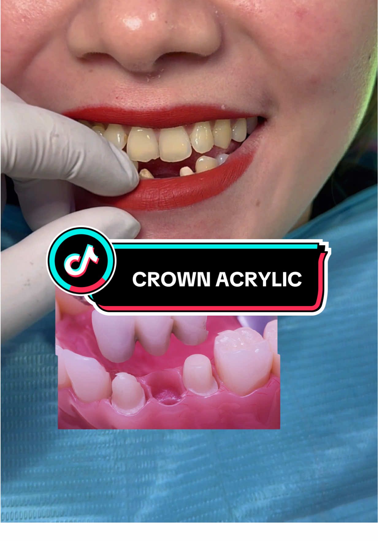 “Crown bridge permanen lebih nyaman di pakai karena tidak memakai gusian/plat •Step by Step Treatment Pasang Gigi Palsu di Sinar Dental 1. Reservasi : Janji temu 1-2 hari sebelum ke klinik. 2. (home service): Panggilan ke rumah. 3. Konsultasi Gratis: Via WhatsApp di nomor   📞0856-9564-5717. 4. Pemasangan Gigi Palsu: Di Sinar Dental, kami memberikan garansi setiap pemasangan. 5. Aman Digunakan : Sangat aman digunakan untuk beraktivitas sehari-hari. LOKASI KLINIK: 1. 📍Jakarta Selatan 2. 📍Tangerang Selatan ⚠️Perlu Diingat - Tidak menerima pesanan secara online. - Banyak yang mengatas namakan Sinar Dental, kalian harus hati-hati, Sampai jumpa di klinik kami🙏😇 #gigipermanen #crownbridge #mahkotagigi #jembatangigi #sarunggigi 