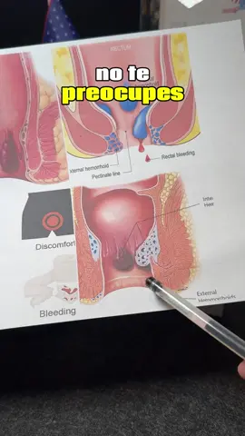 #hemorrhoids #hemorrhoidrelief #foryoupage #tiktokmademebuyit #bodycareproducts 