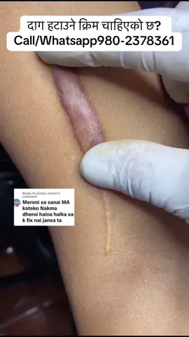 #foryou #scar #operation #stretchmarks #viralvideo 