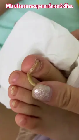 Funky nails? Not anymore. These patches are SAVING toes 🦶 #NailTok #FootCare #FungalNails #Nailfix #BeforeAndAfter          