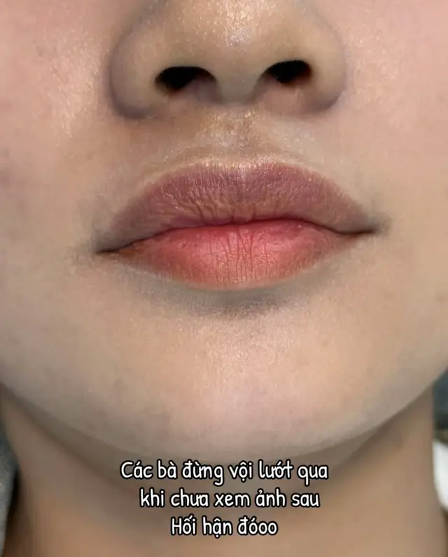 Filler hàn xịn giá chỉ từ 999k, bảo hành check thuốc thoải mái các bà ib tui tư vấn nhé 
