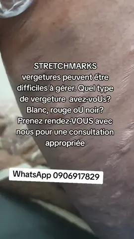 STRETCHMARKS vergetures peuvent ếtre difficiles à gérer. Quel type de vergeture  avez-voUs? Blanc, rouge oU noir? Prenez rendez-VOUS avec nous pour une consultation appropriée#traitement #tictokrdc🇨🇩🇨🇩🇨🇩👌 #laser 