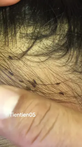 Remove lice 