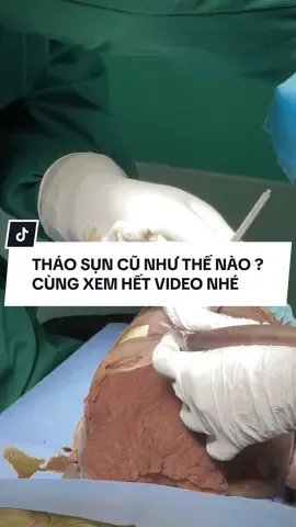 Tháo sụn cũ , đặt lại sụn mới như thế nào . Cùng xem hết video nhé #fyp #xuhuong #trending #lamdep #nangmui 