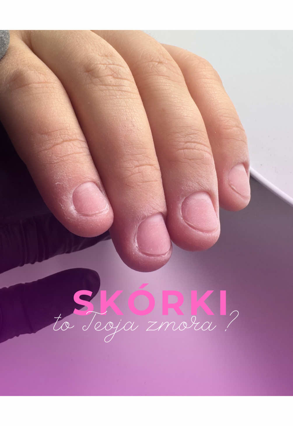 Skórki Twojej klientki wywołują u Ciebie dreszcze? 😱 A chciałabyś z łatwością je opracować? 💅 Mam dla Ciebie prostą wskazówkę ⬇️ 🔸 Podnieś drewnianym patyczkiem przyklejony nabłonek – to ułatwi pracę i sprawi, że frez nie będzie się „ślizgał” po powierzchni. 🔸 Wykończ opracowanie skóry bufferem – dzięki temu efekt będzie gładki, a stylizacja estetyczna i trwała. ✨ 💡 Pamiętaj – to właśnie takie małe triki robią ogromną różnicę w komforcie pracy i wyglądzie stylizacji! Masz wątpliwości, czy robisz to dobrze? 🤔 👉 Napisz do mnie prywatnie albo zostaw w komentarzu słowo SKÓRKI – podpowiem Ci, jak to ogarnąć 🌸