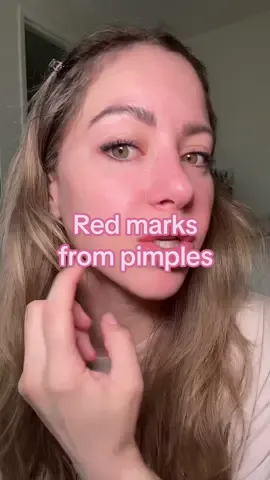 My skin tone has improved so much  #fyp #clearskin #acne #pimples #skincare @CLEARSTEM Skincare 