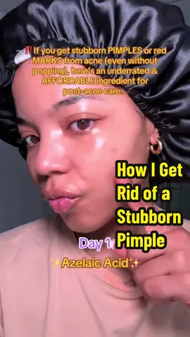 I DO NOT use diluted ACV and azelaic acid in the same routine ❌ I either alternate them every few days at night, or apply azelaic acid as a spot treatment in the morning and then use ACV at night. Majority of the time I use azelaic acid just for stubborn, deep pimples, but some people use it all over their face. If you’re doing that, I recommend using ACV 2–3 nights a week, give your skin in between a break, and the other 2-3 days use azelaic acid (which can be AM or PM) or you can just stick with the product you prefer more. Because both are exfoliants, I don’t risk layering them in the same routine, especially with sensitive or dry skin. And remember: a little goes a long way with azelaic acid! Brand @The Ordinary 10% Azeleic Acid #SelfCare #acne #azaleicacid #pimples #affordableskincare 